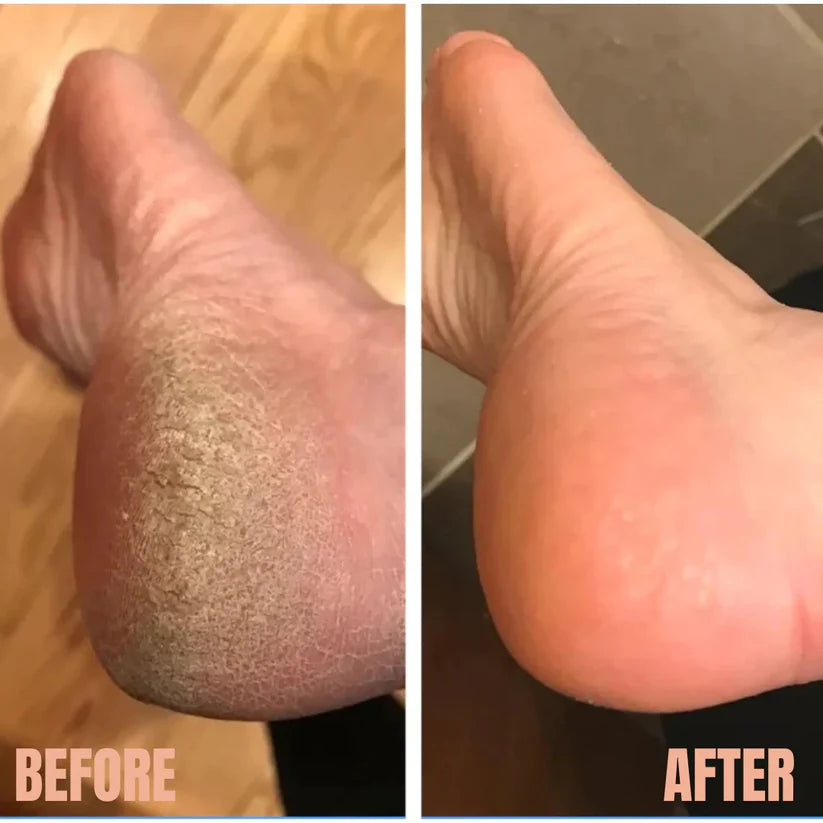 Bodywears SmoothSpin™ Electric Pedicure Tool